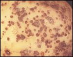 powdery scab